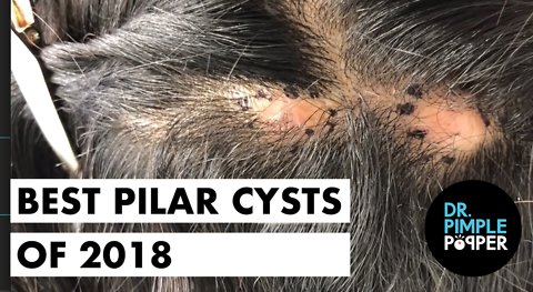 Best of Dr Pimple Popper 2018 pilar cysts