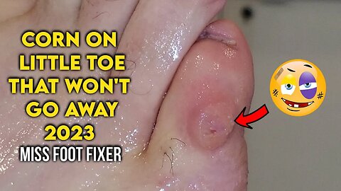CORN ON LITTLE TOE THAT WON'T GO AWAY ** TIPS TO AVOID THEM ** BY FAMOUS PODIATRIST MISS FOOT FIXER