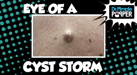 Eye of a Cyst Storm