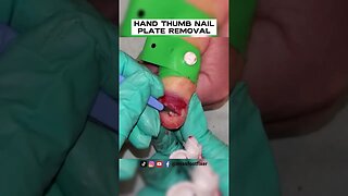 HAND THUMB NAIL PLATE REMOVAL [ NAIL AVULSION ] BY FOOT SPECIALIST MISS FOOT FIXER