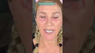 How To Fade Under Eye Wrinkles with Mesotherapy at Home! What to learn more? #shorts