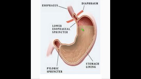 Apr. 2, 2024 AM / Acid Reflux, GERD & Heartburn and discussion...