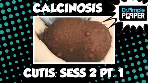 Calcinosis Cutis Session Two, Part One