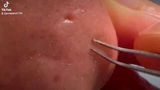 Satisfying Whiteheads Removal!!