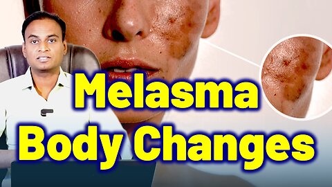 Changes in the body due to Melasma | Melasma Treatment & Cure | Melasma Remedy Solution | Homeopathy