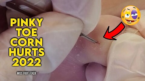 EXTRACTION OF A PINKY TOE CORN THAT HURTS ALOT BY FOOT DOCTOR MISS FOOT FIXER