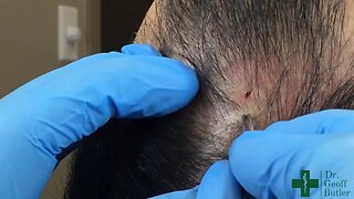 Removal of a Pilar Cyst