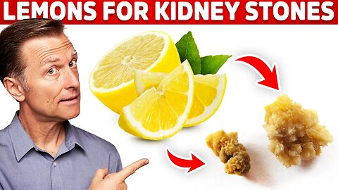 Eliminate Kidney Stones With Lemons – Kidney Stone Causes & Lemon Benefits – Dr.Berg