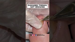 DAMAGED TOENAIL NOT GROWING 👣 IS IT NAIL FUNGUS??? 👣 FULL TREATMENT BY MISS FOOT FIXER