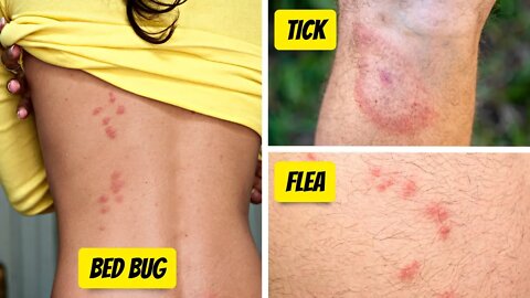 What Bit Me? How To Identify The Most Common Bug Bites