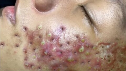 Acne Treatment and Blackhead Removal 2021 #02 || Blackheads on Nose || Nose Blackheads