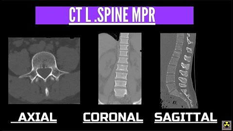 CT L Spine MPR Workup on a Cannon 320 Slice Scanner .