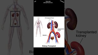 Kidney transplant