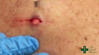 Removal of a Superficial Epidermal Cyst, completely intact