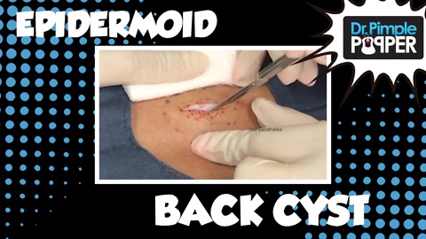 Dr Pimple Popper: A Back Cyst like RICOTTA