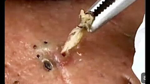 Removal and pimple popper cystic acne extraction whiteheads 105