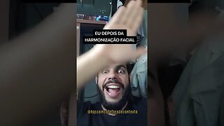 EU DEPOIS DA HARMONIZAÇÃO FACIAL