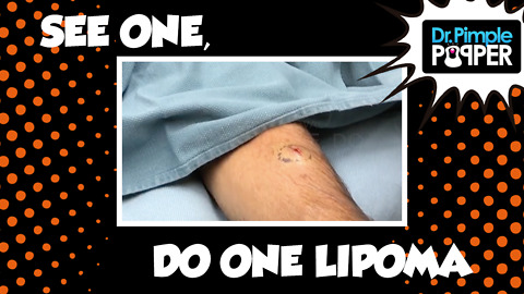See One, Do One, Lipoma