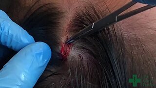 Removal of a Pilar Cyst