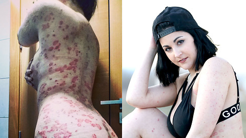 Model Promotes Psoriasis Positivity | SHAKE MY BEAUTY