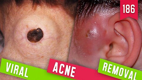 VIRAL ACNE REMOVAL / VIRAL BEAUTY / PIMPLE POPPING