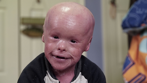 This Boy's Skin Grows Too Fast, Puts Him At Great Risk | BORN DIFFERENT