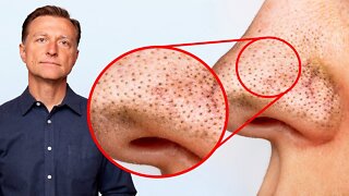 Remove Blackheads PERMANENTLY Simply by Tweaking Your DIET