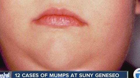 Mumps at SUNY Geneseo