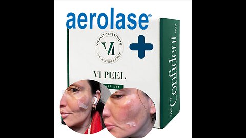 Aerolase + VI Peel Precision Plus Combo Treatment