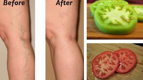 Natural Remedies for Varicose Veins