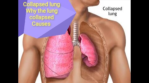 Collapsed lung | cause of collapsed of lung | pneumothorax