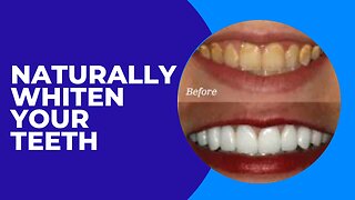 How To Dramatically Whiten Teeth In 5 Minutes NATURALLY!!