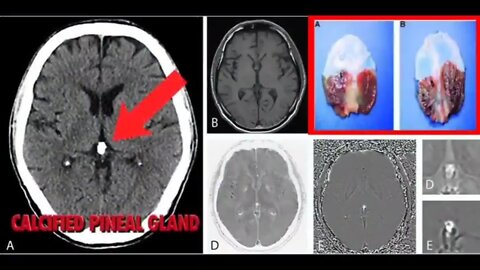 DECALCIFYING THE PINEAL GLAND