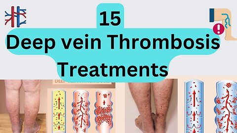 15 Deep vein thrombosis treatments
