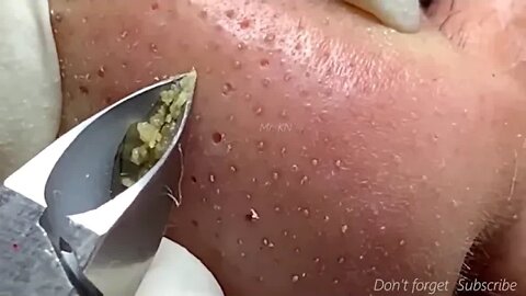 Blackhead Removal - HD Remoção de cravos