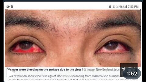 BIRD FLU BLEEDING EYEBALLS? (WARNING GRAPHIC CONTENT)