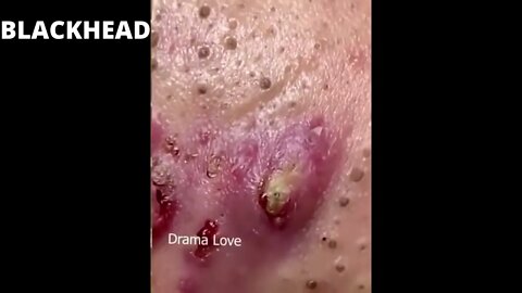 Face with lots of pimples and blackheads! Removal of blackheads and pimples