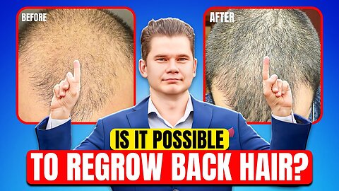 Is It Possible To Recover Hair On Completely Bald Head?