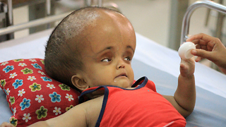 Baby With Swollen Head Hopes For Life-Saving Surgery: BORN DIFFERENT