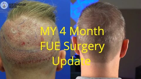 My FUE Hair Transplant Before And After 4 Months