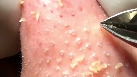 Oddly satisfying Nose Blackheads Removal!! Whitehead cravo pimple
