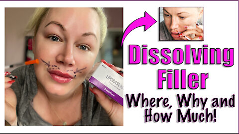 Dissolving Filler : Where, Why and How Much? | Code Jessica10 Saves you Money!