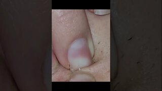 Remoção de Cravos e Espinhas - Remove Squeezing Blackheads and Pimples - Just Relax | Apenas Relaxe