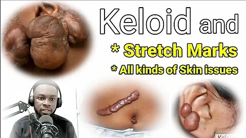 Keloid, Stretch Masks and all Skin Problem | Heal Yourself GH | Heal Yourself Herbal #subscribe #cr7