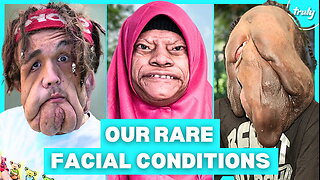 9 Of The Rarest Facial Conditions In The World | BORN DIFFERENT