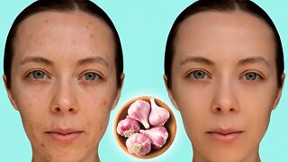 How To Get Rid Of Acne Overnight With Garlic