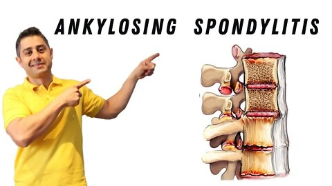 Ankylosing Spondylitis core exercises