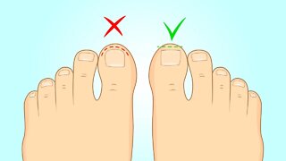 How to Fix Ingrown Toenails Fast at Home