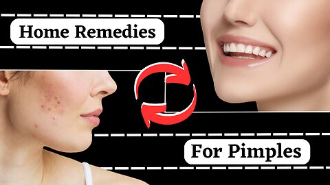 Effective Home Remedies to Stop Pimples: Clear Skin Solutions at Home