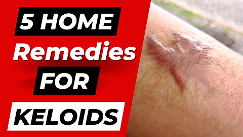 5 Home Remedies For Keloids